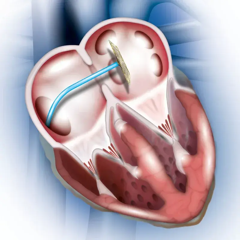 Structural Heart Procedures